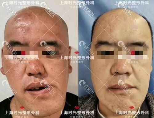 手術矯正龍魚嘴歪需要多長時間恢復？（手術矯正“龍魚嘴歪”并非醫(yī)學術語需召回與手術恢復過程）