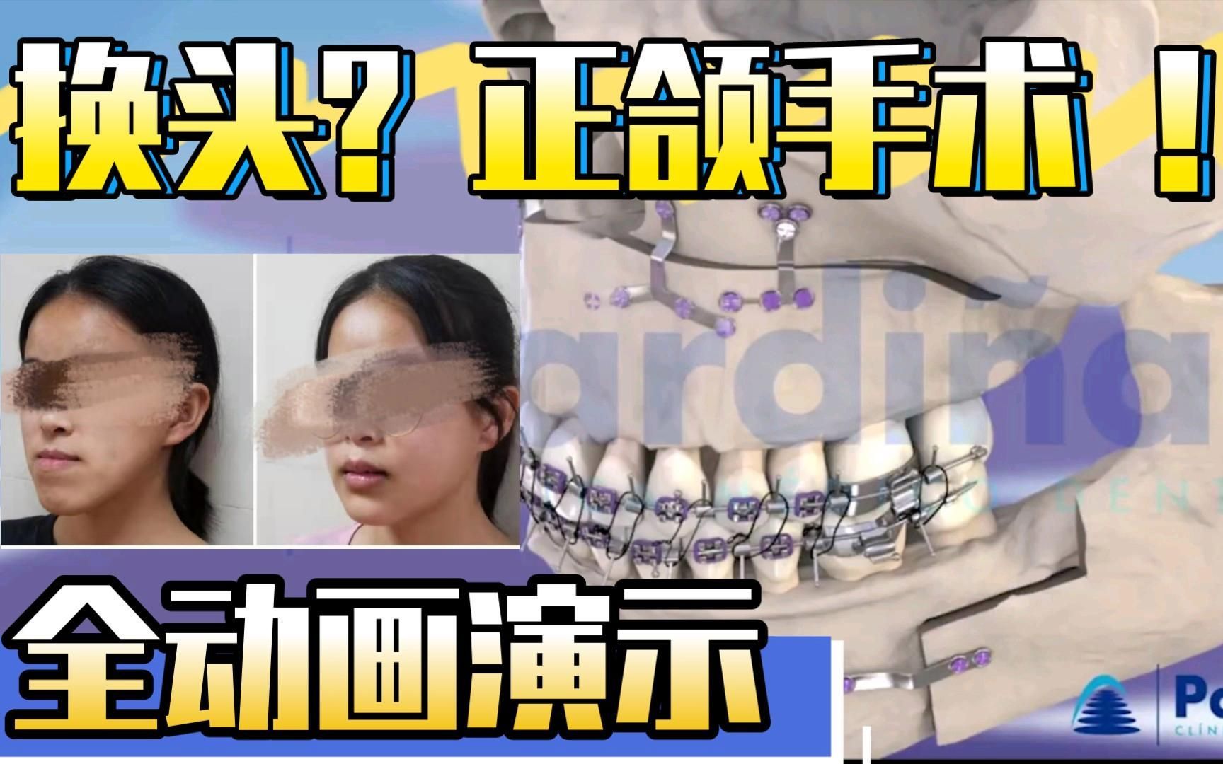 手術矯正龍魚嘴歪需要多長時間恢復？（手術矯正“龍魚嘴歪”并非醫(yī)學術語需召回與手術恢復過程）