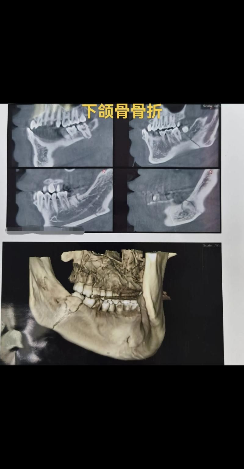 如何判斷龍魚下頜是否骨折？（真實(shí)龍魚下頜骨折的診斷通常需要專業(yè)的獸醫(yī)雖非直接對(duì)比圖））