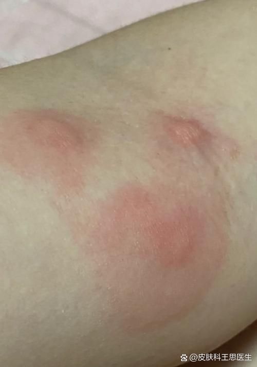 如何判斷自己是否對鱘龍魚過敏?(———醫(yī)學診斷鱘龍魚過敏診斷流程詳解) 龍魚百科 第3張 如何判斷自己是否對鱘龍魚過敏?(———醫(yī)學診斷鱘龍魚過敏診斷流程詳解) 如何判斷自己是否對鱘龍魚過敏?(———醫(yī)學診斷鱘龍魚過敏診斷流程詳解) 龍魚百科 第3張