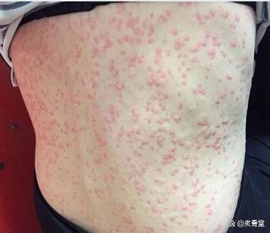 如何判斷自己是否對鱘龍魚過敏?(———醫(yī)學診斷鱘龍魚過敏診斷流程詳解) 龍魚百科 第4張 如何判斷自己是否對鱘龍魚過敏?(———醫(yī)學診斷鱘龍魚過敏診斷流程詳解) 如何判斷自己是否對鱘龍魚過敏?(———醫(yī)學診斷鱘龍魚過敏診斷流程詳解) 龍魚百科 第4張