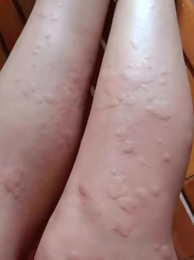 如何判斷自己是否對鱘龍魚過敏?(———醫(yī)學診斷鱘龍魚過敏診斷流程詳解) 龍魚百科 第1張 如何判斷自己是否對鱘龍魚過敏?(———醫(yī)學診斷鱘龍魚過敏診斷流程詳解) 如何判斷自己是否對鱘龍魚過敏?(———醫(yī)學診斷鱘龍魚過敏診斷流程詳解) 龍魚百科 第1張