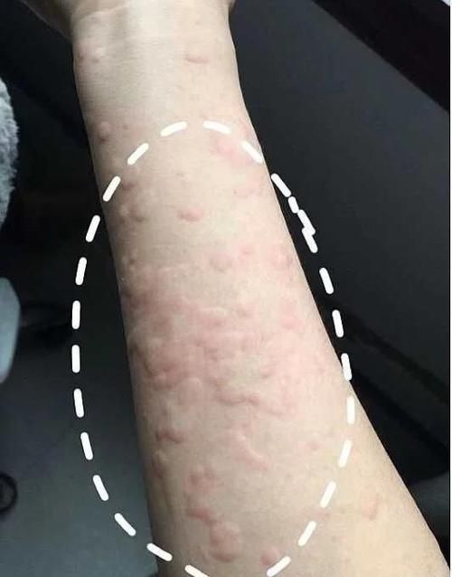 如何判斷自己是否對鱘龍魚過敏?(———醫(yī)學診斷鱘龍魚過敏診斷流程詳解) 龍魚百科 第6張 如何判斷自己是否對鱘龍魚過敏?(———醫(yī)學診斷鱘龍魚過敏診斷流程詳解) 如何判斷自己是否對鱘龍魚過敏?(———醫(yī)學診斷鱘龍魚過敏診斷流程詳解) 龍魚百科 第6張