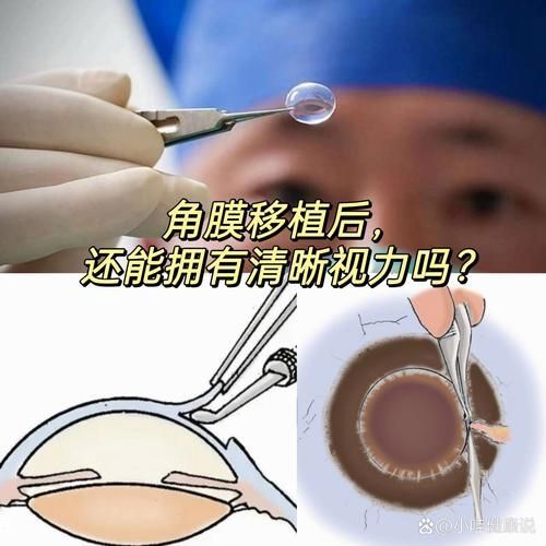 重度蒙眼病如何治療（西安地區(qū)治療重度蒙眼病治療重度蒙眼病的治療方案）
