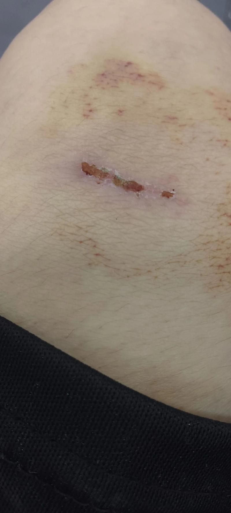 龍魚爛鰓蓋手術后如何護理（龍魚爛鰓蓋手術后護理）