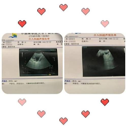 如何判斷腹水是否好轉