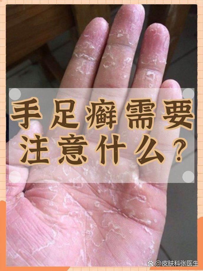 手部真菌感染如何治療，手部真菌感染怎么辦