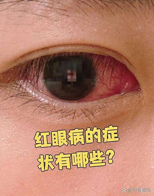 銀龍魚紅眼病的癥狀有哪些？，關(guān)于銀龍魚紅眼病