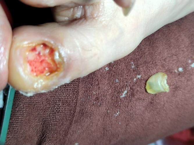 被龍魚咬傷后需要多久恢復，被龍魚咬傷后多久可以洗澡
