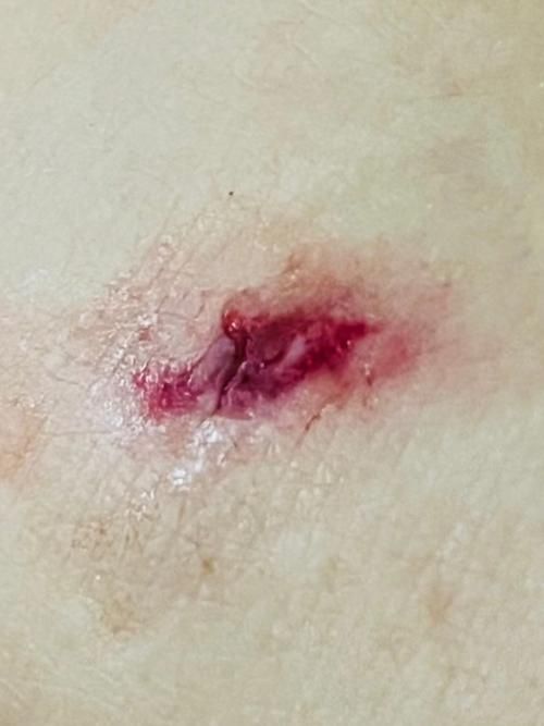 被龍魚咬傷后需要多久恢復，被龍魚咬傷后多久可以洗澡