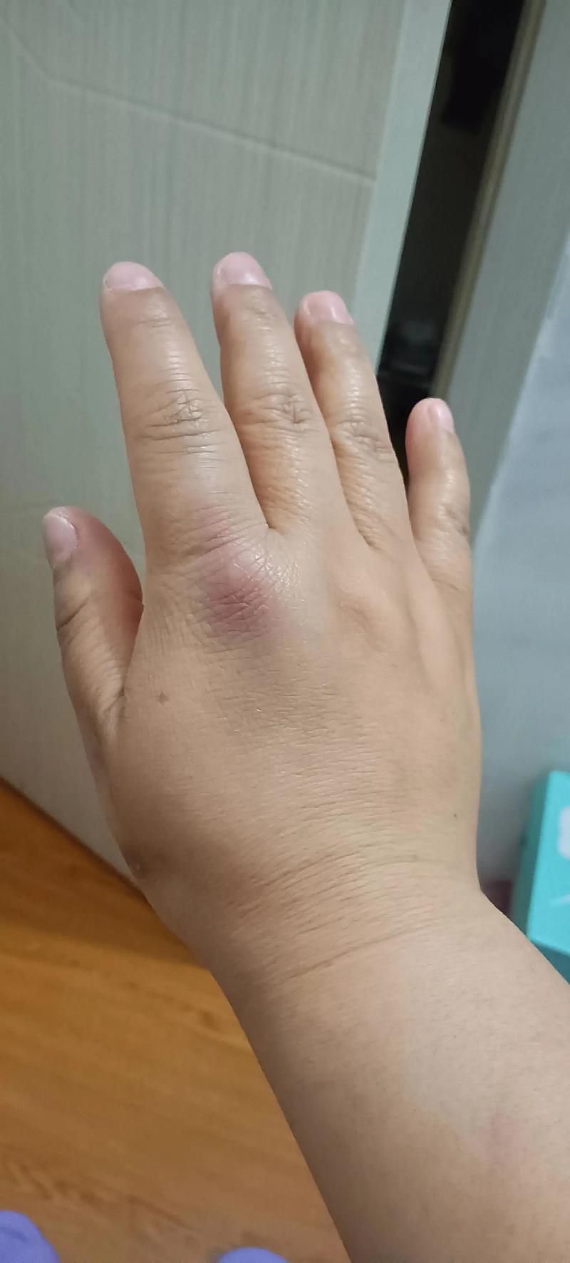 被龍魚咬傷后需要多久恢復，被龍魚咬傷后多久可以洗澡