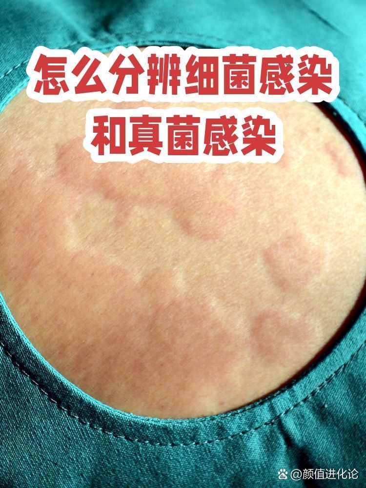 真菌和細(xì)菌感染的癥狀有何不同，——真菌感染和細(xì)菌感染的區(qū)別