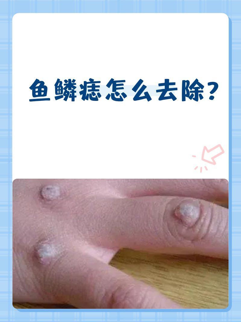 魚鱗痣怎么去除，魚鱗痣怎么去除魚鱗痣5種方法詳解魚鱗痣去除方法