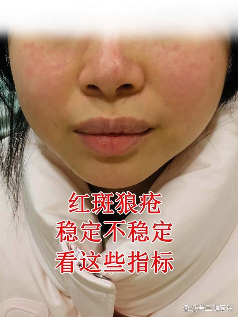 紅斑病治療期間多久復查一次合適，紅斑狼瘡復查必知的關鍵指標關乎你的健康叁三