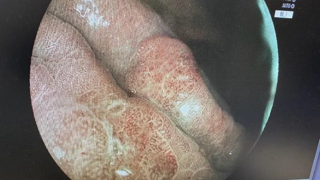 有哪些天然方法可以治療魚鰓蓋潰爛，天然方法治療魚鰓蓋潰爛