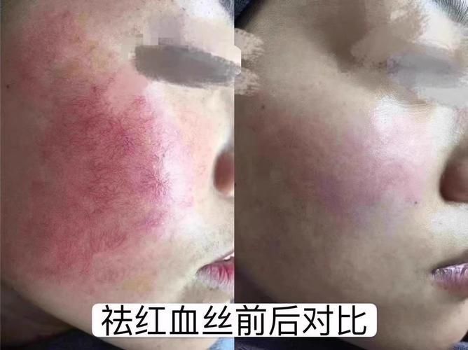 有哪些護膚品適合紅血絲患者，紅血絲患者如何選擇護膚品