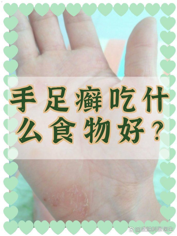 哪些食物有助于預防手部真菌感染，如何預防手部真菌感染？