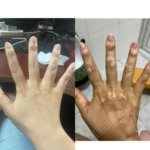能否提供魚鰭根部充血的治療前后對比圖，如何治療魚鰭根部充血