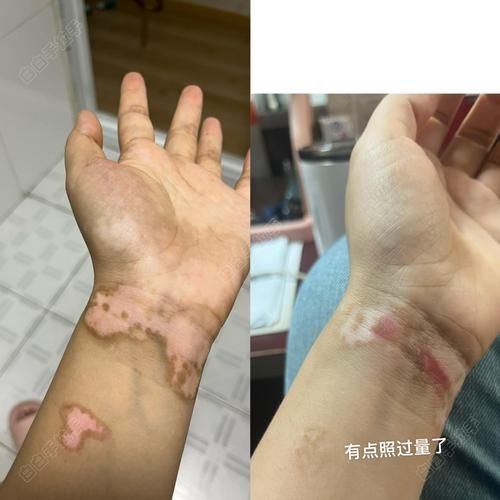 能否提供魚鰭根部充血的治療前后對比圖，如何治療魚鰭根部充血