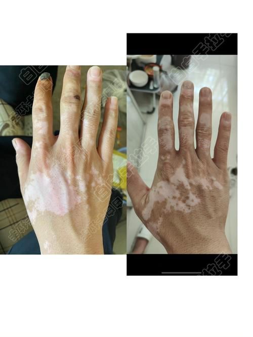 能否提供魚鰭根部充血的治療前后對比圖，如何治療魚鰭根部充血