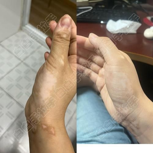 能否提供魚鰭根部充血的治療前后對比圖，如何治療魚鰭根部充血