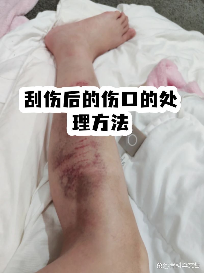 物理刮傷后如何護理，刮傷后怎么辦