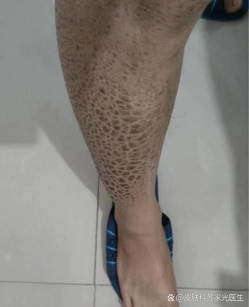 魚鱗皮膚病圖片，如何區分不同類型的魚鱗病？