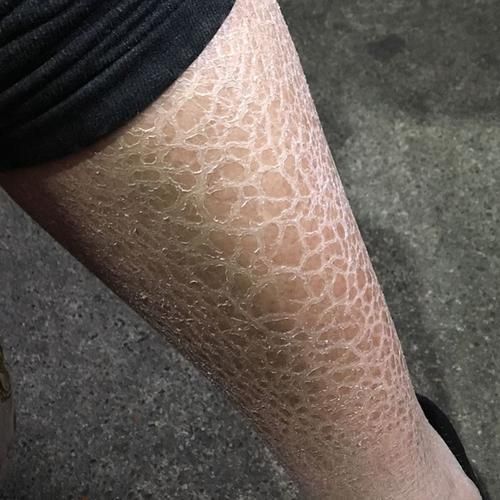 魚鱗皮膚病圖片，如何區分不同類型的魚鱗病？