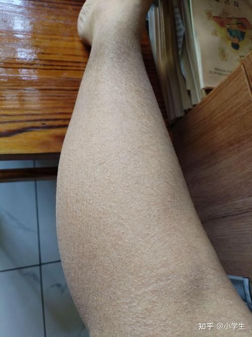 魚鱗皮膚病圖片，如何區分不同類型的魚鱗病？