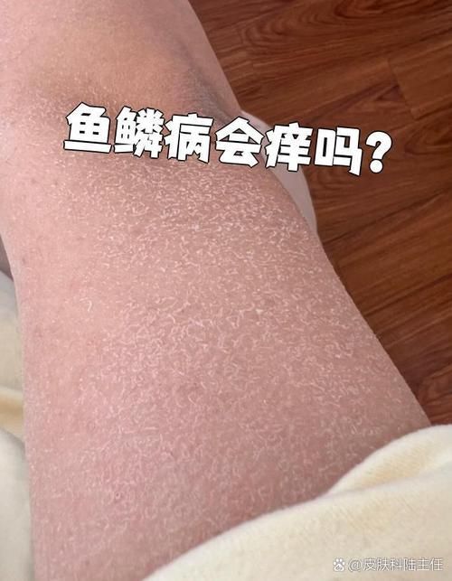 魚鱗皮膚病圖片，如何區分不同類型的魚鱗病？
