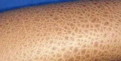 魚鱗皮膚病圖片，如何區分不同類型的魚鱗病？