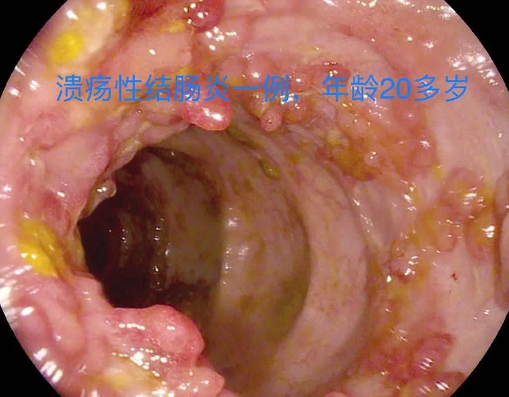如何區分不同病因引起的腸炎，關于腸炎診斷
