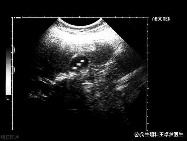 如何判斷雷龍腹水的嚴重程度，如何判斷雷龍腹水