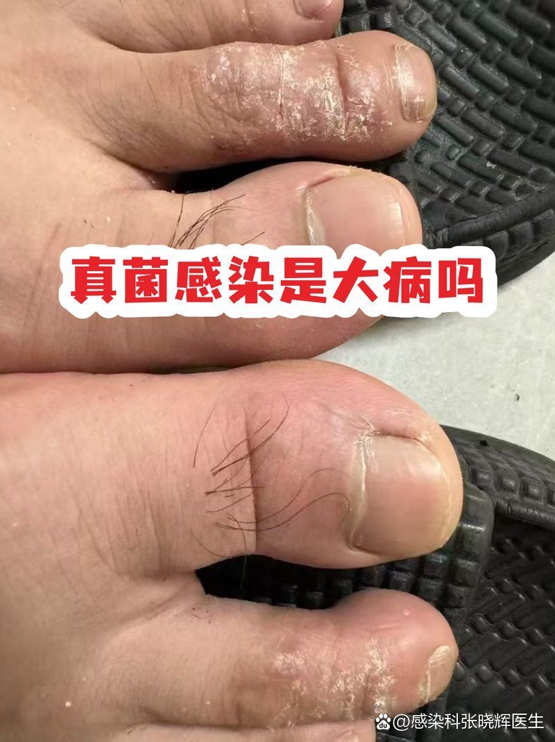 真菌感染和細菌感染哪個更嚴重，真菌感染和細菌感染哪個更嚴重，不能一概而論