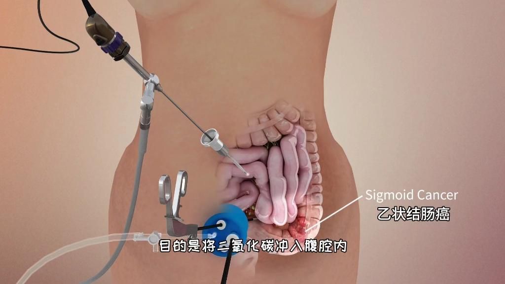 能提供更詳細的手術步驟嗎，中大醫院婦產科周銓手術全過程圖解