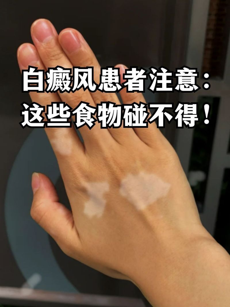 白點病治療期間需要忌口嗎，白點病治療期間多久見效，