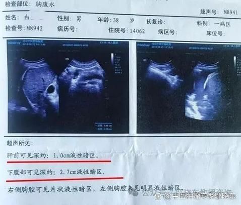 如何判斷魚腹水是否復發，百度健康-去問診（百度健康-去問診”和“百度健康-去問診”