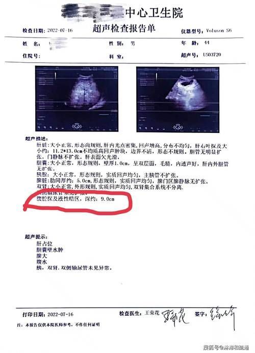 如何判斷魚腹水是否復發，百度健康-去問診（百度健康-去問診”和“百度健康-去問診”