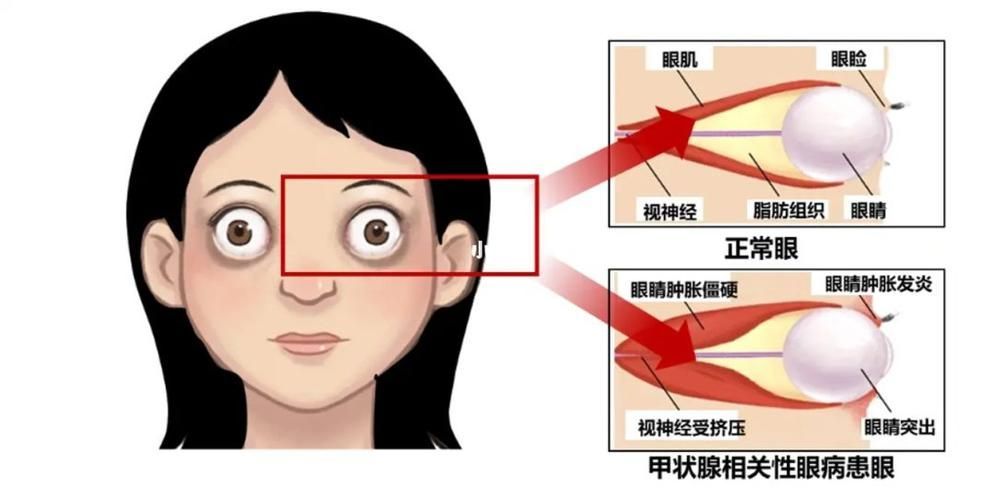 哪些飼料有助于預防突眼病，斗魚突眼病的飼料預防機制詳解（exophthalmos）