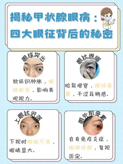 哪些飼料有助于預防突眼病，斗魚突眼病的飼料預防機制詳解（exophthalmos）