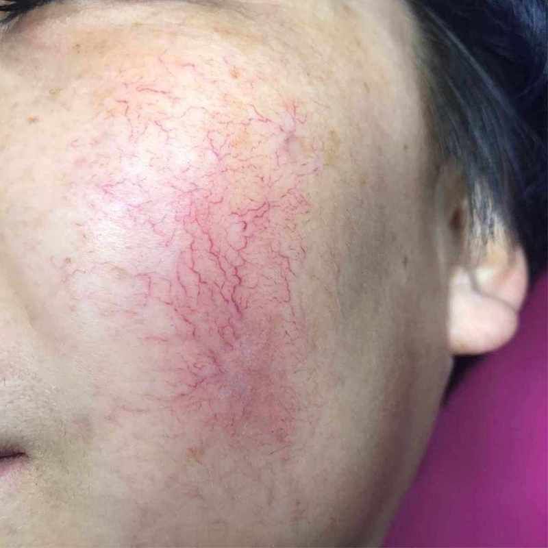 如何判斷紅血絲是否復發，如何判斷紅血絲復發