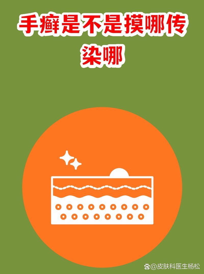 有哪些手部真菌感染的常見誤區，手部真菌感染是怎么回事