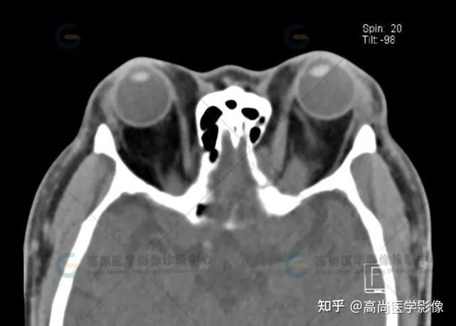 有哪些藥物可以幫助治療魚突眼，“魚突眼”的藥物治療