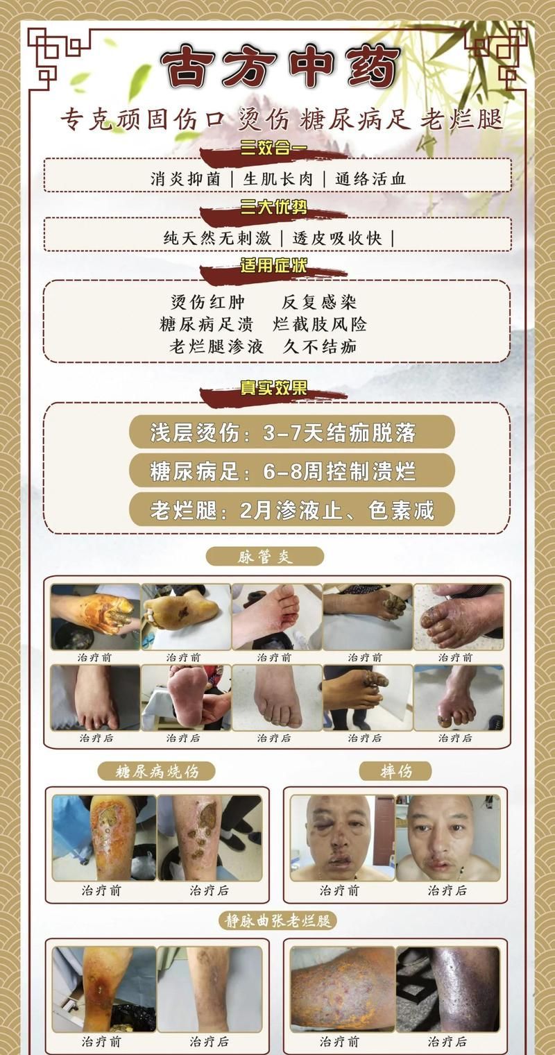 爛身病能徹底治愈嗎，爛身瘡如何治療