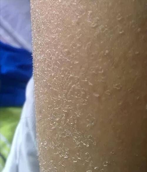 能否提供更多關(guān)于魚鱗病的圖片，如何判斷自己是否患有魚鱗病 能否提供更多關(guān)于魚鱗病的圖片，如何判斷自己是否患有魚鱗病 龍魚百科 第5張