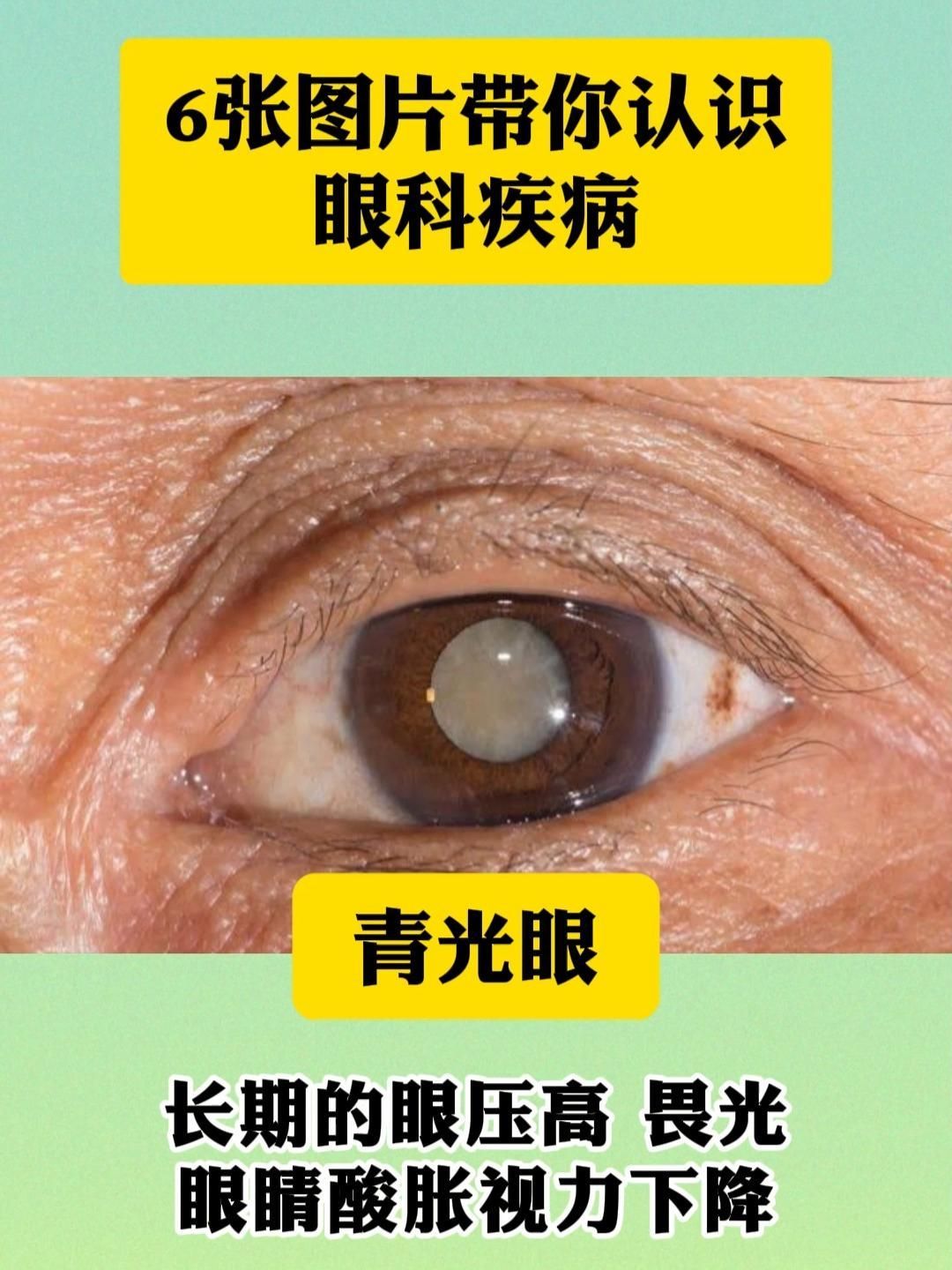 如何區分蒙眼病與其他眼部疾病，全民小視頻，如何判斷自己是否患有蒙眼病