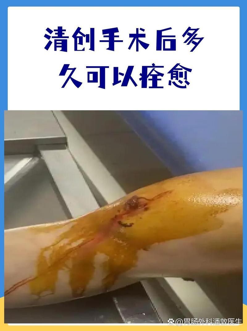 清創(chuàng)手術后需要多長時間恢復，清創(chuàng)手術后多久可以恢復正?；顒?></span>胃腸外科潘敦醫(yī)生胃腸外科潘敦醫(yī)生<br><span id=