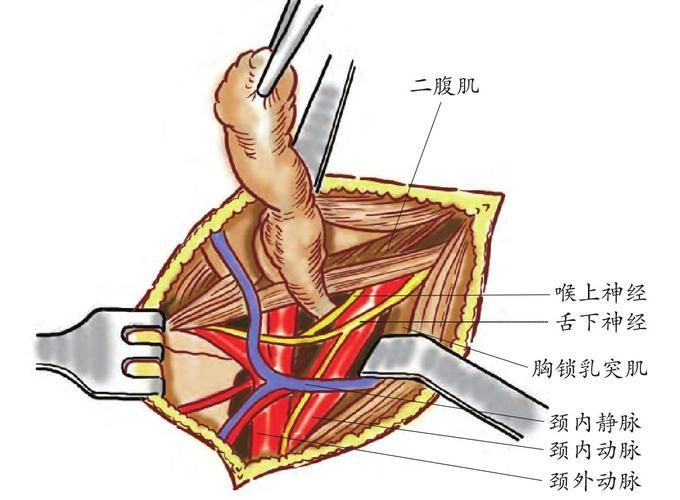 翻鰓手術風險大嗎，百度健康-去問診,
