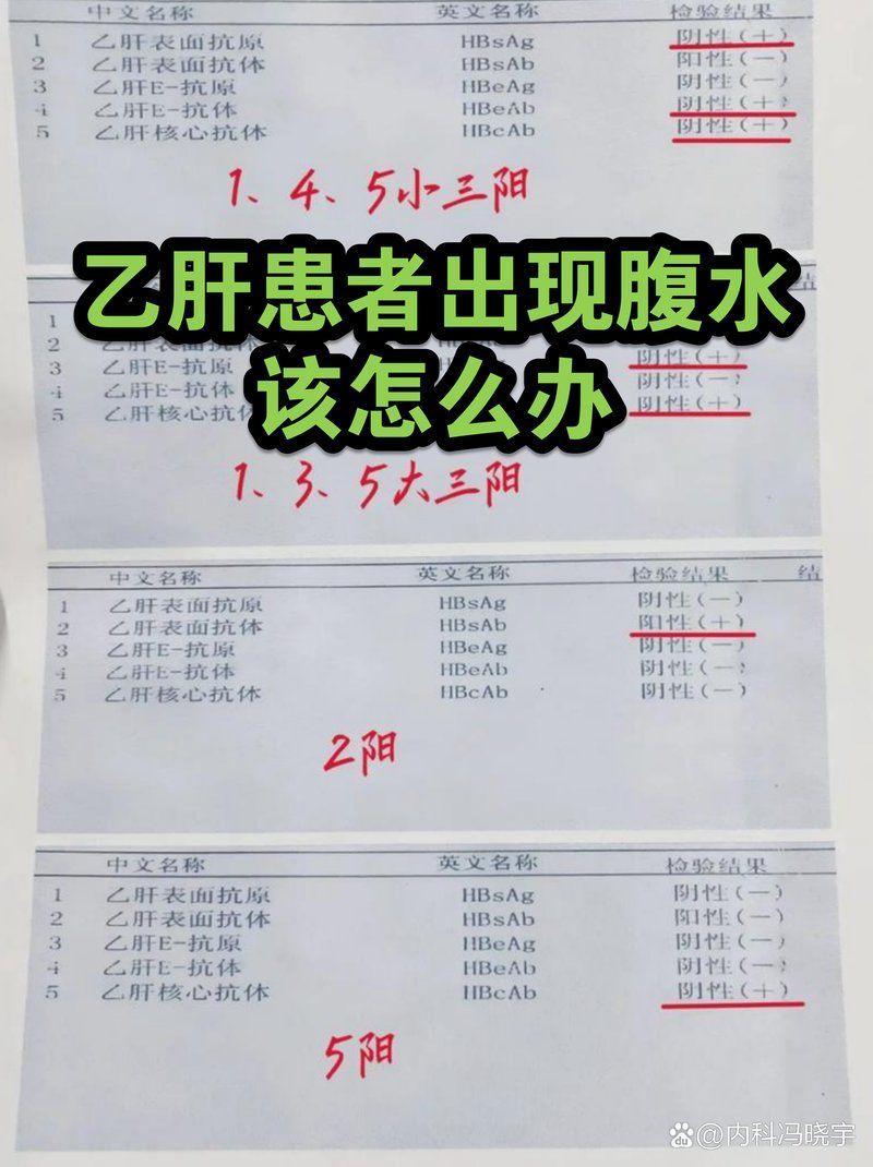 病毒性感染引起的腹水病如何治療，內(nèi)科馮曉宇，有哪些病毒性感染會導致腹水