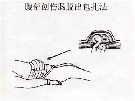 腹部外傷有內(nèi)臟脫出時，腹部外傷內(nèi)臟脫出處理示意圖，現(xiàn)場包扎，盡快送醫(yī)